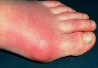 Megáll bump a tetején a felvonó okok és a kezelés (bump) Bump a tetején a lábát a nő okai és kezelése