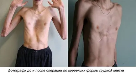 Marfan-szindróma - leírását a betegség, a kezelés, a fényképet (Marfan) Marfan-szindróma - leírását a betegség, a kezelés, fotók