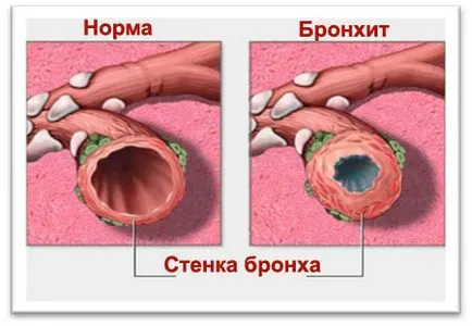 Hogyan kell kezelni a hörghurut bronchitis Hogyan kell kezelni a hörghurut bronchitis