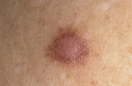 A szilárd, puha bőr, fibróma - fénykép eltávolítása, kezelése, népi módszerek okai