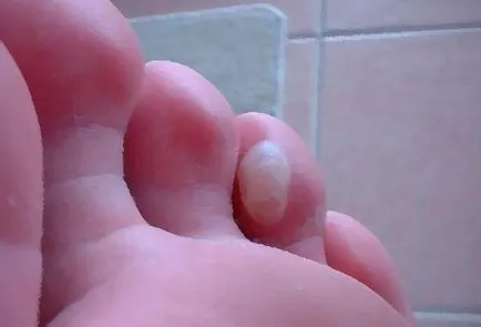Hólyagok a lábujjak kezelésére piercinges, népi jogorvoslati megelőző víz