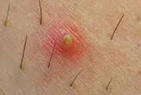 Benőtt Hair - okai, tünetei, diagnózisa és kezelése