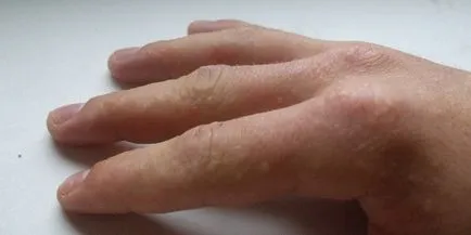 Hólyagok az ujjak - az okok a vizes bőrkiütések, és a kezelés (ujjak) Hólyagok az ujjak - mi okozza a vizes bőrkiütések és kezelés