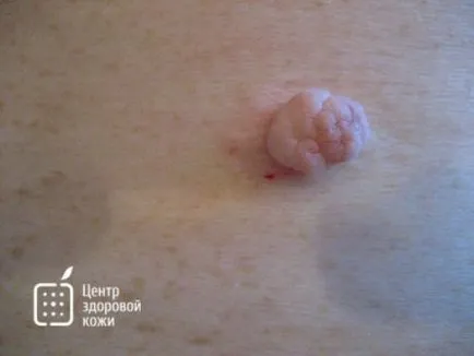 Minden a bőr fibroma fotókkal (a bőrön) Minden a bőr fibroma fotókkal