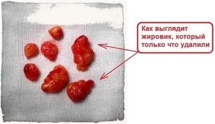 Wen (lipóma) a testen okainak, a tünetek, a kezelés