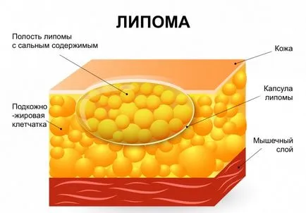 Wen (lipóma) a testen okainak, a tünetek, a kezelés