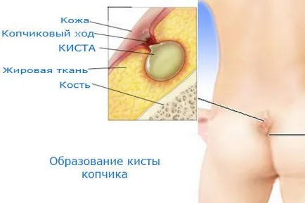 Mert amit a tailbone ciszta Mert amit a tailbone ciszta