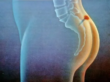 Mert amit a tailbone ciszta Mert amit a tailbone ciszta