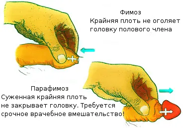 Az élvezet phimosis