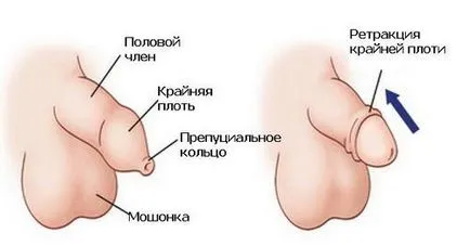 Az élvezet phimosis