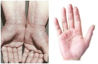 Hormonális kenőcs dermatitis