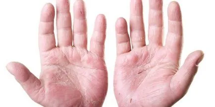 Hormonális kenőcs dermatitis Hormonális kenőcs dermatitis