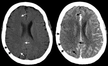 Hydrocephalus kezelése népi jogorvoslati