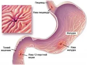 A rendszer a gyomorfekélyek gyógyulásában