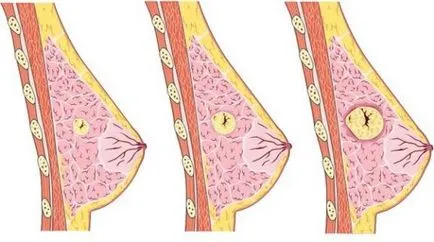 Mi rostos breast