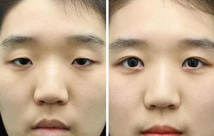 Epicanthus mi ez