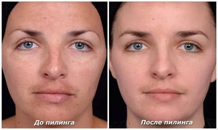 Hogyan készítsünk egy otthon peeling