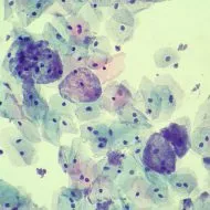 DNS Gardnerella vaginalis ez DNS Gardnerella vaginalis ez
