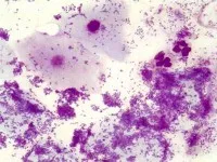DNS Gardnerella vaginalis ez DNS Gardnerella vaginalis ez