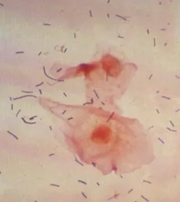 DNS Gardnerella vaginalis ez DNS Gardnerella vaginalis ez