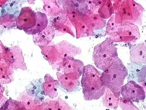 DNS Gardnerella vaginalis ez DNS Gardnerella vaginalis ez