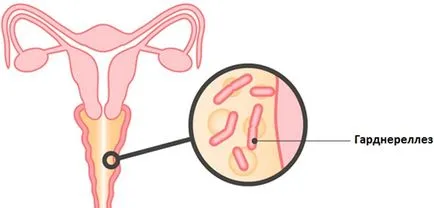 DNS Gardnerella vaginalis ez DNS Gardnerella vaginalis ez