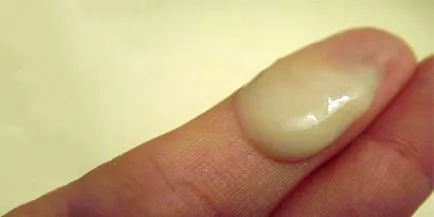 Mi gonorrhoea férfiak