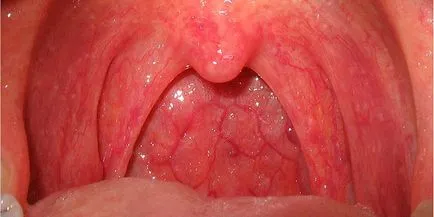 Mi gonorrhoea férfiak