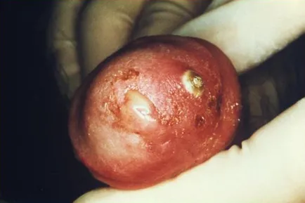 Mi gonorrhoea férfiak Mi gonorrhoea férfiak