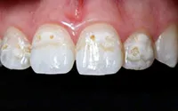 szuvasodás a dentin szuvasodás a dentin