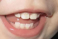 szuvasodás a dentin szuvasodás a dentin