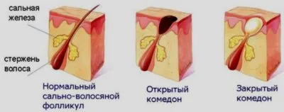 Mi mitesszerek az arcon Mi mitesszerek az arcon