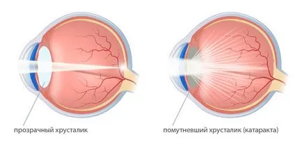 lencse kezelésére