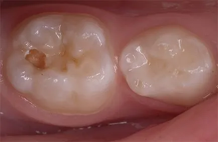 szuvasodás a dentin