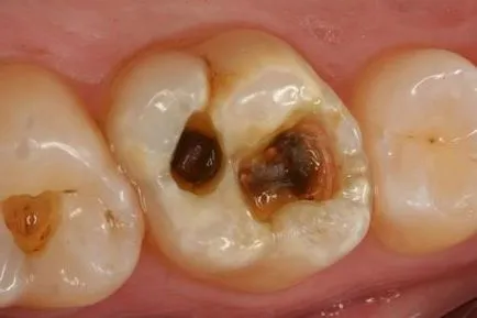 szuvasodás a dentin