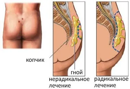 Mert amit a tailbone ciszta Mert amit a tailbone ciszta