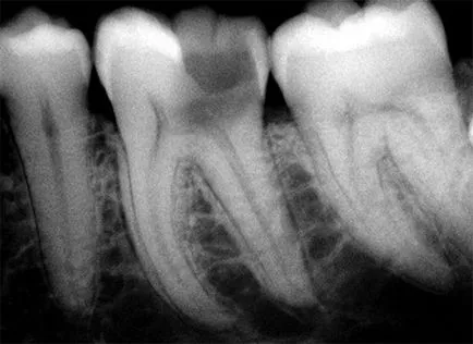 szuvasodás a dentin