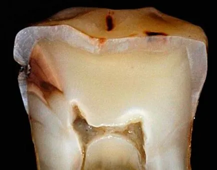 szuvasodás a dentin