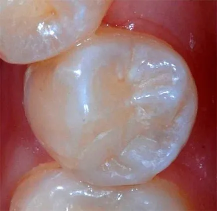 szuvasodás a dentin