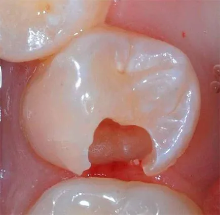 szuvasodás a dentin