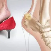 polyosteoarthrosis kezelés