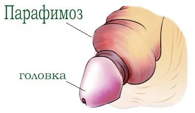 Az élvezet phimosis