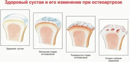 polyosteoarthrosis kezelés