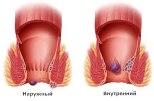 Mik Aranyér, amit ő