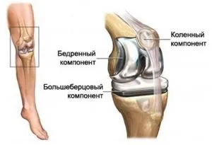 Teljes térdprotézis