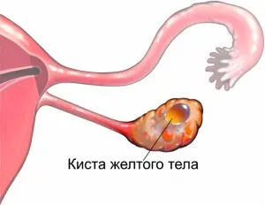Miért vannak kialakítva ciszták