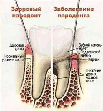periodontitis fokozat periodontitis fokozat