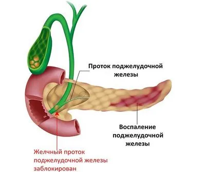 Mi pancreatitis a hasnyálmirigy Mi pancreatitis a hasnyálmirigy