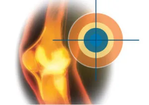 polyosteoarthrosis kezelés