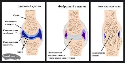 polyosteoarthrosis kezelés polyosteoarthrosis kezelés
